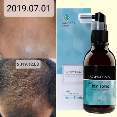 바로티나 탈모양제 뉴헤어토닉 24주 임상완료 정수리 탈모고민 기능성 앰플 자 모발 두피스케일 관리