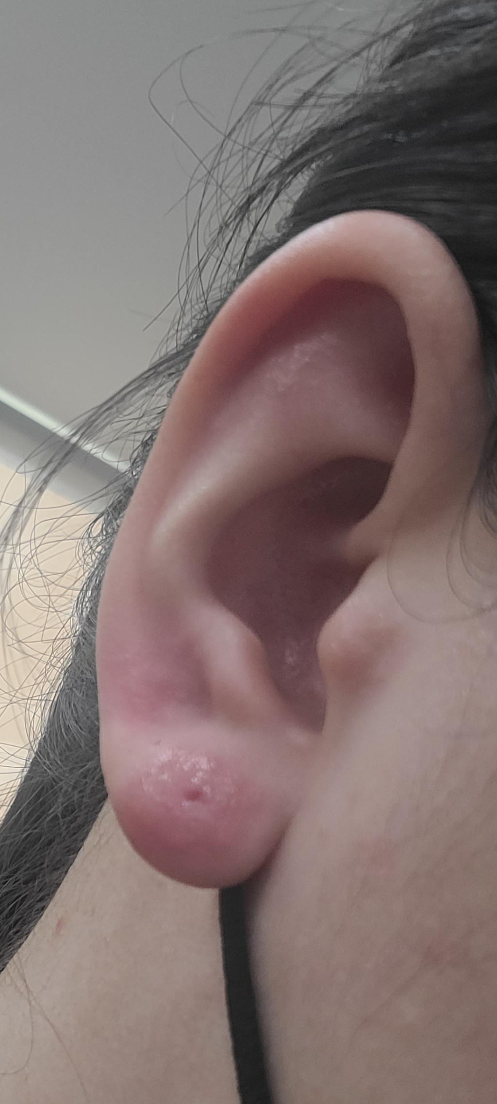 AE 귀지압패치