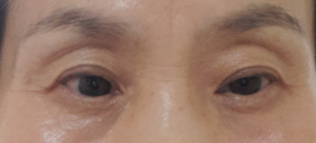 미간주름 이마주름 슈퍼파워리프팅 5분 크림