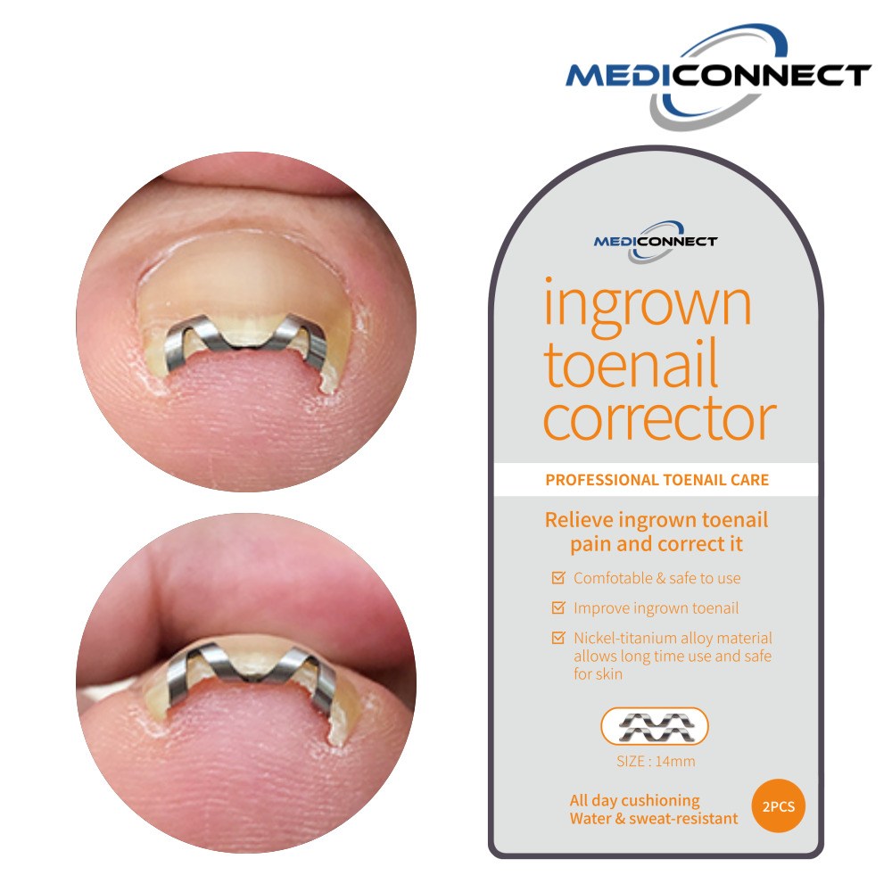 내향성 발톱 고민 해결! 신뢰할 수 있는 메디커넥트 내성발톱 교정기
