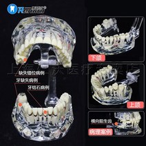치아모형 모델 구강 모델 표준 모델 신경과 의사와 환자 간의 의사 소통을 통한 의치, 2번 결손 병리학적 모델 1