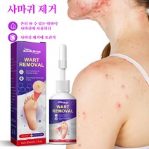 South Moon 발바닥 티눈 제거 발가락 티눈 치료 무통 제거액, 20ML