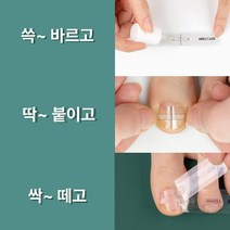 퍼펙토 내성발톱 치료 교정 팁 의료기기 세트, 20mm TOOL세트