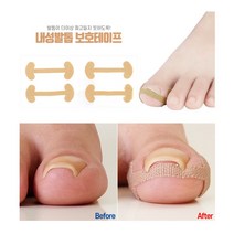 [풀리줄리] 살속 파고드는 발톱 교정 발가락 붙이는 밴드 테잎 통증 완화 방지 살색 4개 1세트 참지말고 붙