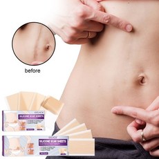 실리콘테이프제왕절개