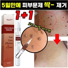 [국내배송] 1+1/2+2 손 발 제거 펜 피부 치료 제거 연고, 2+2