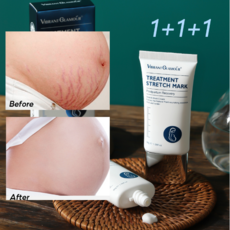 스트레치 마크 크림 튼살크림 임산부 피부 집중 케어