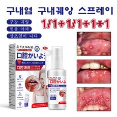 구내염 구내궤양 스프레이 혀가 마르고 갈라지고 잇몸통 미스트