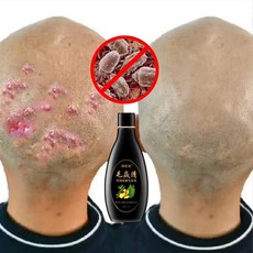 잔머리제거