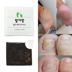 발가락무좀 TOP01