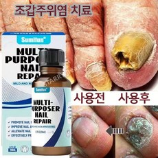 [약국 강력 추천]|발톱무좀약|발톱무좀|무좀|조갑사상균증|발톱|관리손톱영양제 천연 성분 안전하고 자극이 없다
