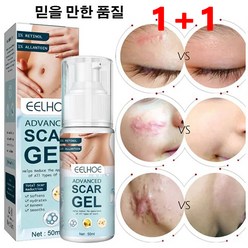 1+1흉터 제거 연고 50ml 흉터 개선 젤 오래된흉터제거연고 상처흉터연고 쌍꺼풀 흉터/제왕절개 흉터/수술 흉터 여드름 흉터/비후형 흉터/화상 흉터, 50ml*4+50ml*4, 2개