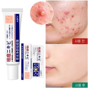 여드름 자국 제거로 여드름 성장 억제 여드름 소실, 30g, 1개, 30g