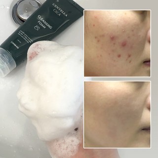 여드름 기능성 클렌징폼 좁쌀 아크네 사춘기 청소년 화장품 수부지 센텔라 시카 클렌저, 1개 여드름 모공 피지 각질 제거 센텔라시카 폼클렌징, 120ml, 1개