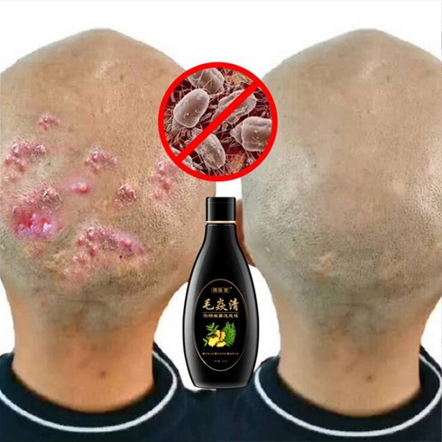 두피 모낭 샴푸 항균 가려움증 진드기 오일 컨트롤 건선 및 클렌징 스킨 케어 제품, 한개옵션0