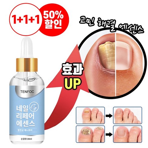 [빠른효과] 1/1+1/1+1+1 손발톱 무좀 에센스 발톱 리페어 손발톱 변색 케어 발톱연화제, 1+1개