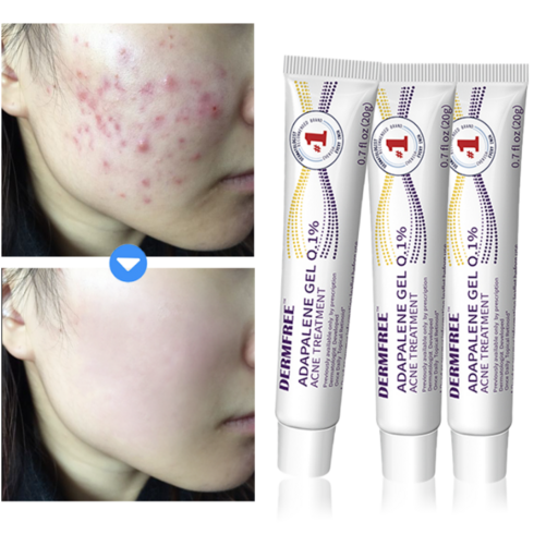 dermfree 리페어 크림 - DERMFREE 여드름 제거 리페어 크림 스팟 케어 문제피부 자국 모공 진정 피지케어 연고, 3개, 20g