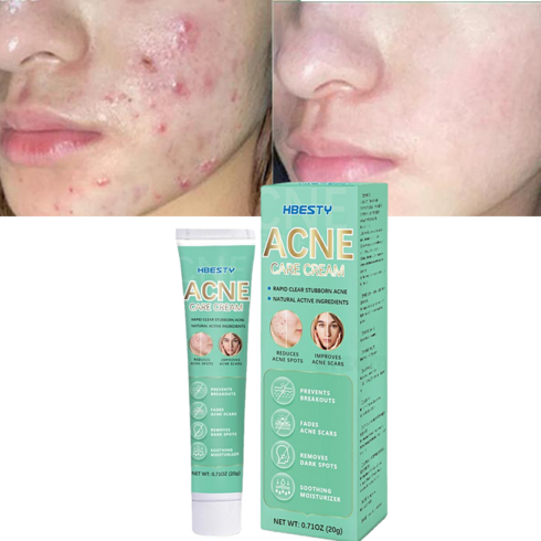 피부 여드름 색소침착 방지 치료 켈로이드 리페어 흉터 제거 연고 재생크림, 20ml, 1개