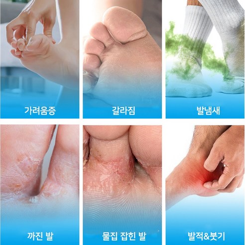 3일 만에 되찾는 깨끗한 발, FDA 인증 무좀 치료제의 놀라운 효과