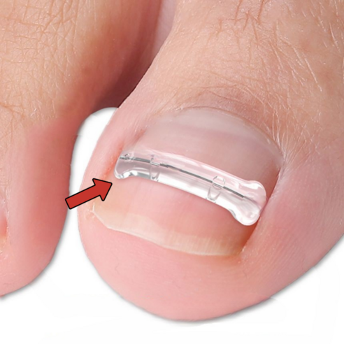 메디플 파고드는 발톱 케어, 새로운 발톱 관리의 시작