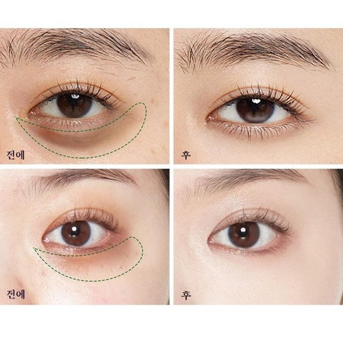 눈밑 문제 해결의 만병통치약