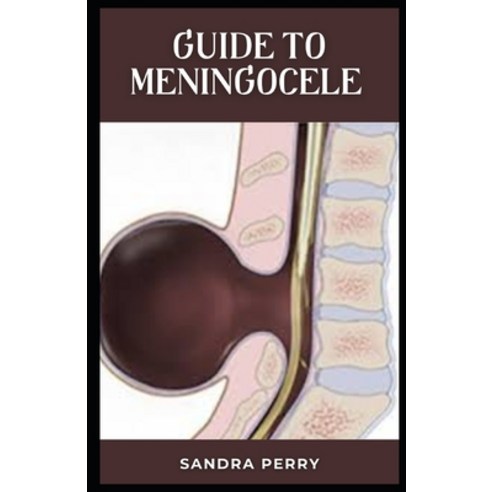 (영문도서) Guide to Meningocele: Meningocele is a type of spina bifida. Paperback, Independently Published, English, 9798393965365