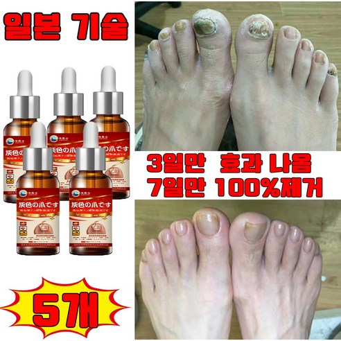 일본 1+1/2+2 손톱 발톱 무좀 영양제 앰플 발톱 관리 케어 손톱발톱 강화제 네일 강화 선물 랜덤 증정, 5개, 30ml