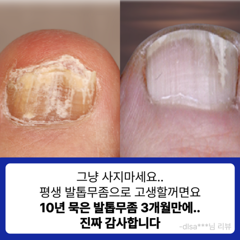 건강한 발톱을 위한 최고의 선택