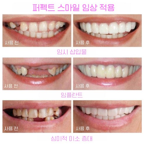 빛나는 미소, 자신감을 되찾아 줄 1+1 틀니 치아미백