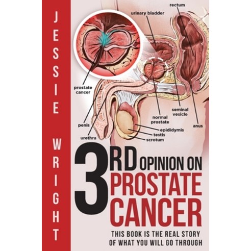 3rd Opinion on Prostate Cancer Paperback, Book Vine Press