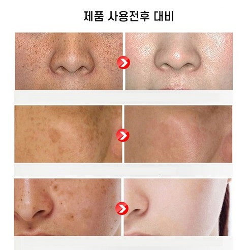 BT 기미 제거 크림으로 피부 복구하기