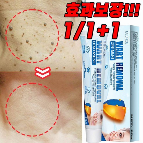 미국기술 1/1+1 얼굴 제거 크림 발바닥 물 편평 제거 연고, 3개, 20g