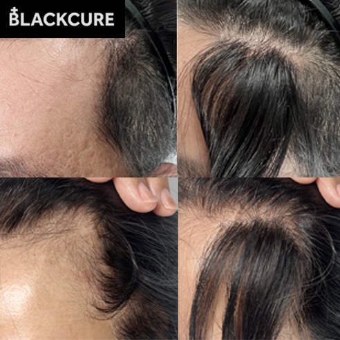 감쪽같은 변신, 자신감을 되찾아줄 비밀 병기 m자가발