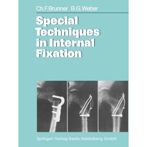 Special Techniques in Internal Fixation Paperback, Springer