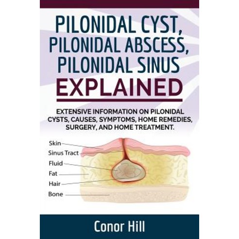 Pilonidal Cyst Fast Healing Guide. Fast Track Guide to Pilonidal Cyst Relief by Understanding the Pilo..., Devine Publishing Worldwide