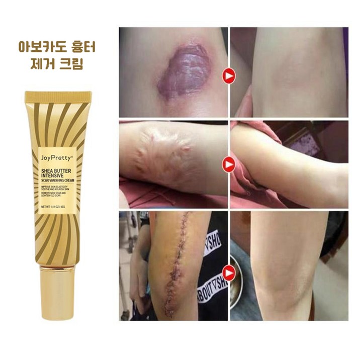 JOYPRETTY 흉터제거연고 수술 화상 상처 흉터 겔, 40g, 1개 대표 이미지 - 수술 흉터 제거 추천