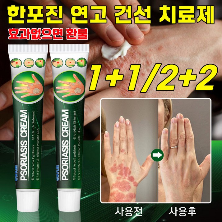 빠른 배송 미국 한포진 연고 건선 연고 치료제 두드러기 피부 가려움증 연고 허브 크림