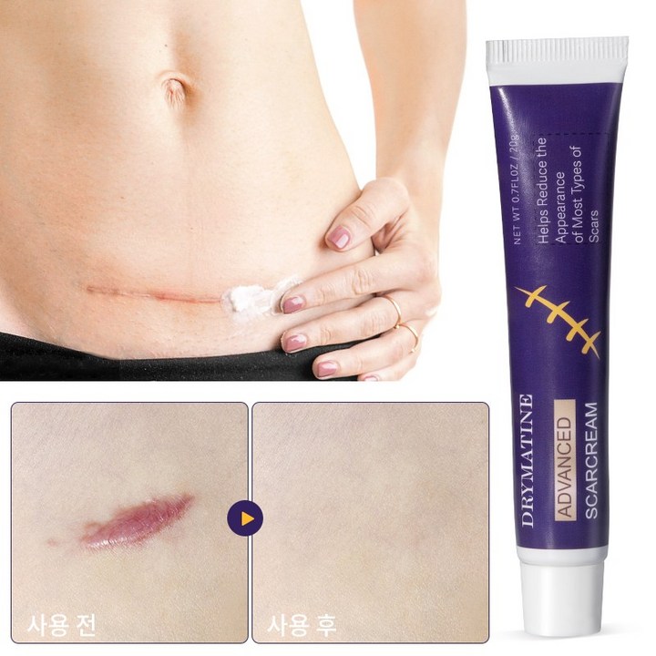 당일배송 DRYMATINE 흉터연고 흉터제거연고 재생크림 상처흉터연고 여드름흉터 수술흉터 화상물집 흉터제거연고 당일배송 DRYMATINE 흉터연고 흉터제거연고 재생크림 상처흉터연고 여드름흉터 수술흉터 화상물집 흉터제거연고